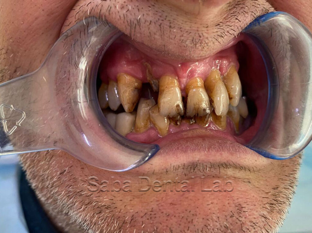 Protesi provvisorie realizzate da Saba dental Lab