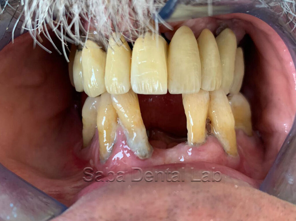 Protesi inferiore realizzata da Saba Dental Lab