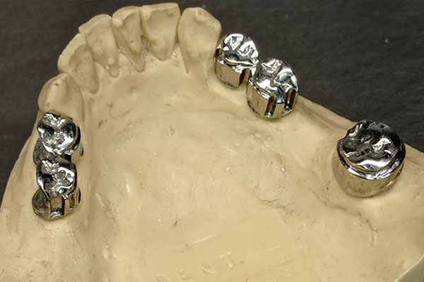 Corone telscopiche realizzate da Saba Dental Lab